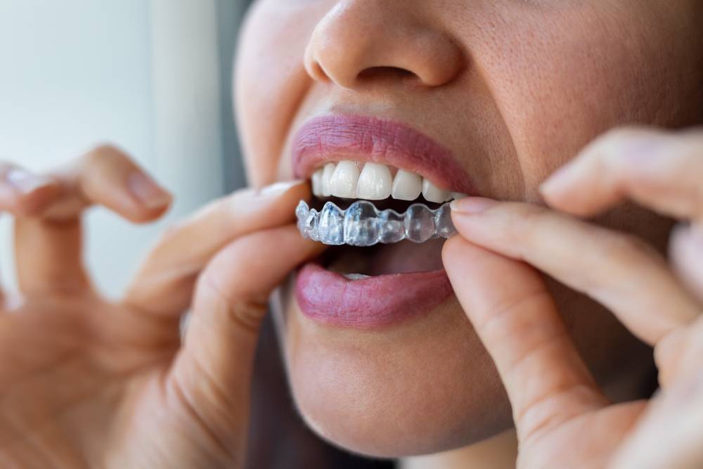 La ortodoncia invisible redefine la belleza dental en la actualidad